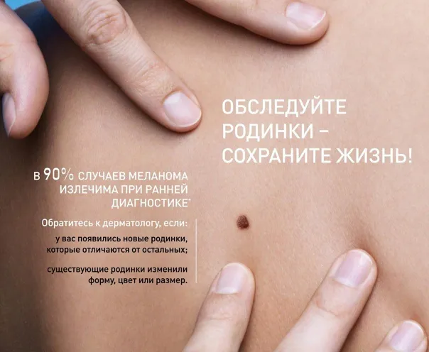 Нижнекамска приглашают на бесплатную диагностику родинок