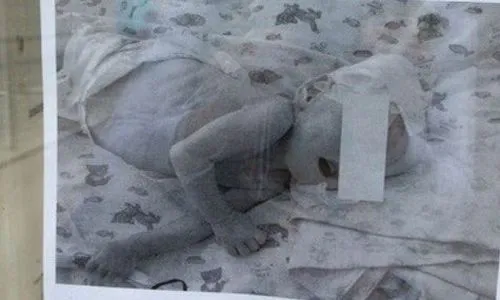 В нижнекамской реанимации уже почти год находится малыш со множественными патологиями развития