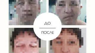В Татарстане врачи провели уникальную операцию, удалив опухоль, которая сдавливала нерв на лице