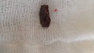 Нижнекамские хирурги удалили осколок бойцу СВО
