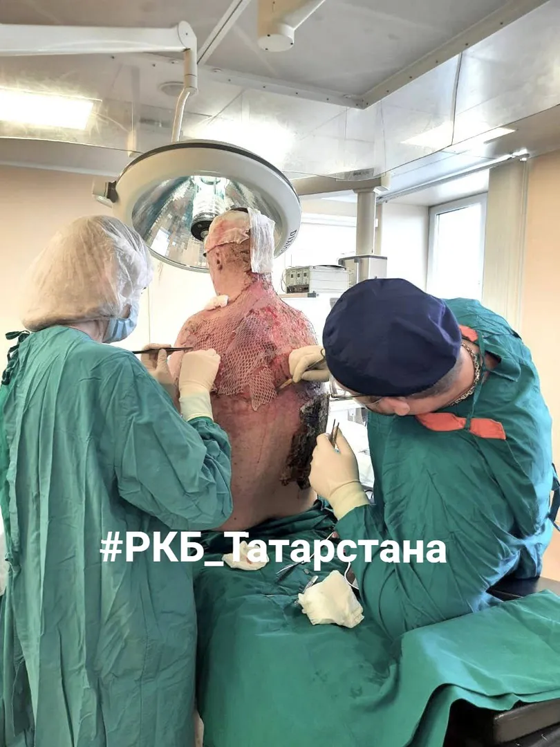8 операций, 10 л перелитой крови: в Татарстане спасли мужчину с 15 % глубоких ожогов